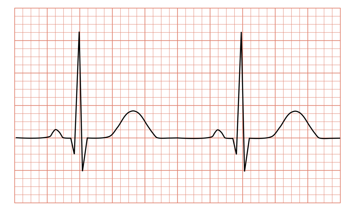 EKG