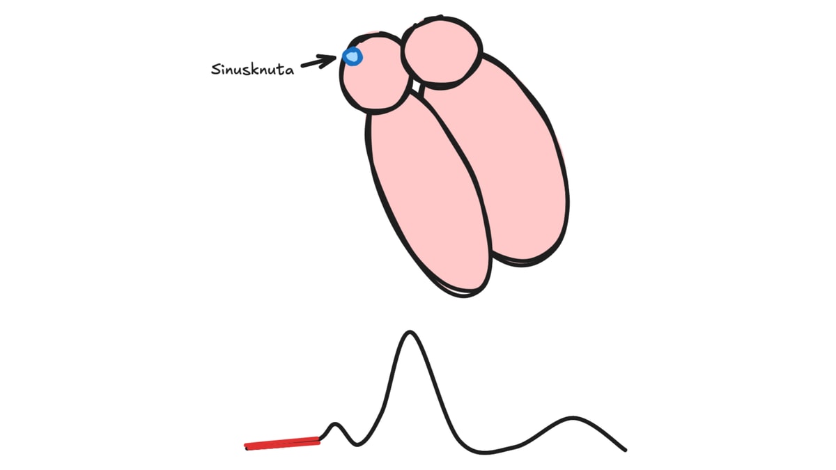 Sinusknuta