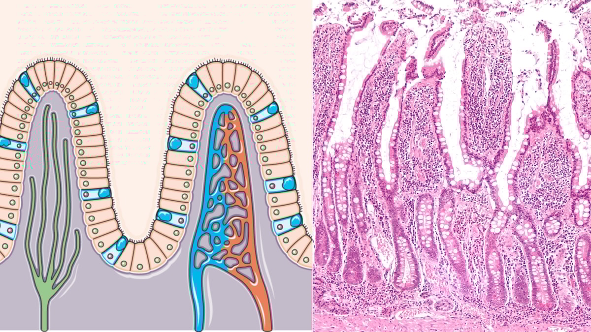 Schematisk bild över villi (vänster). Mikroskopibild på tunntarmens villi (höger).