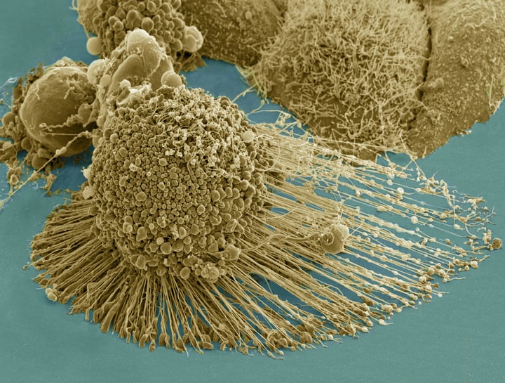En färglagd svepelektronmikroskopisk bild av en HeLa-cell som genomgår apoptos.