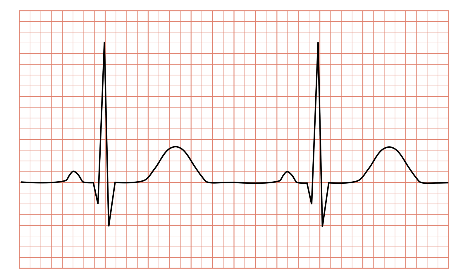 EKG