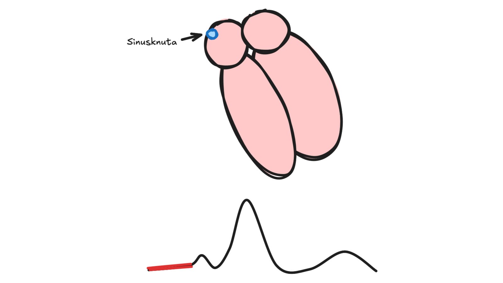 Sinusknuta